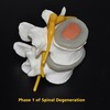 Phase 1 spinal degeneration 800x800
