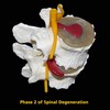 Phase 2 spinal degeneration 800x800